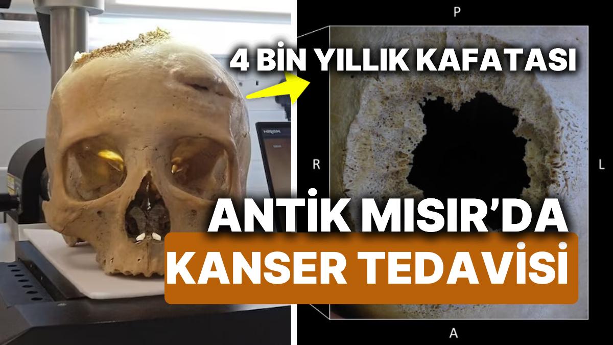 antik-misirda-beyin-kanseri-tedavisi-4-bin-yillik-kafatasi-en-eski-kanser-ameliyatinin-ipuclarini-63zjGllY.jpg