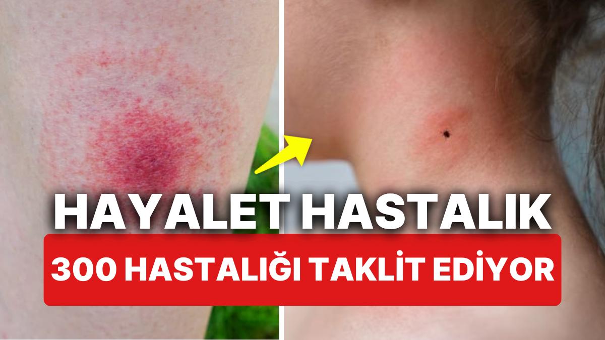 hayalet-hastalik-olarak-biliniyor-uzmanlar-uyariyor-lyme-300-farkli-hastaligi-taklit-ediyor-5SLd83OV.jpg