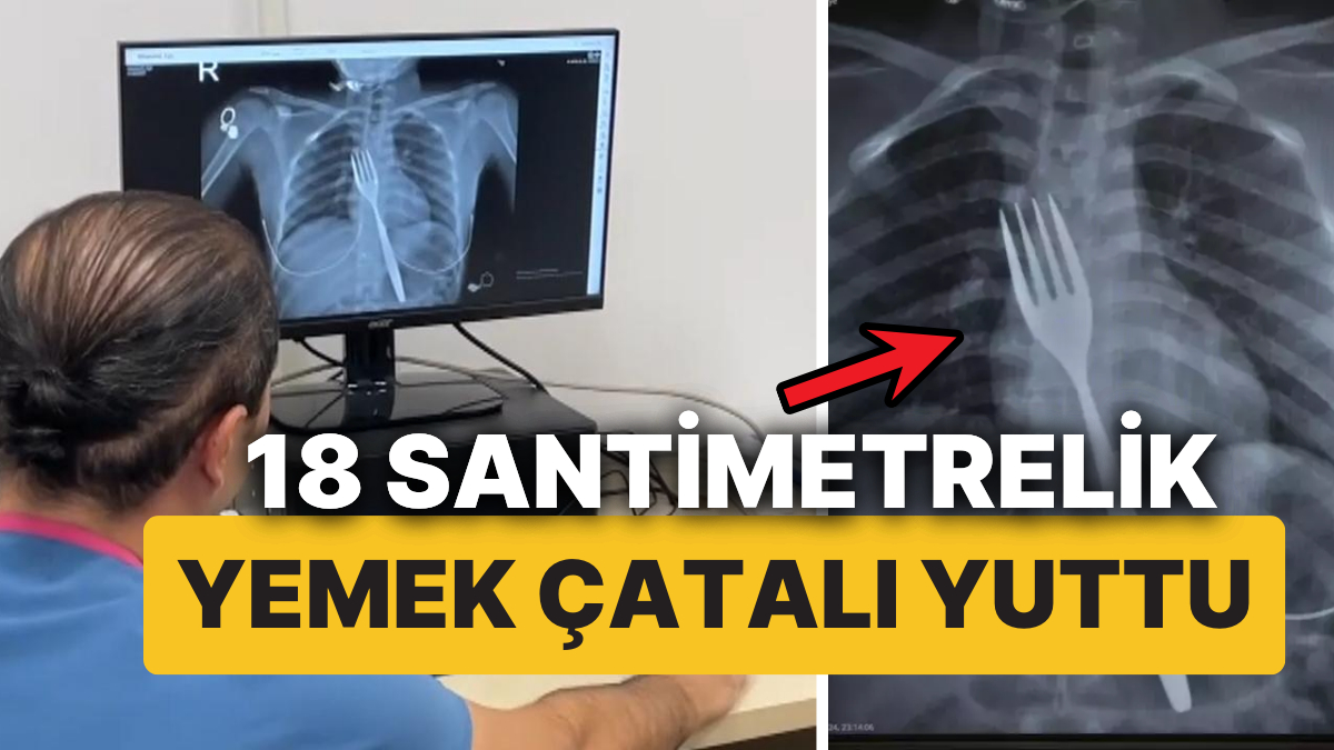 genc-bayanin-yuttugu-18-santimetrelik-yemek-catali-bilimsel-makaleye-bahis-olacak-R8ibUgmb.jpg